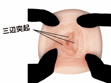 Camphorencer(カンフルエンサー)の三辺ヒダ突起